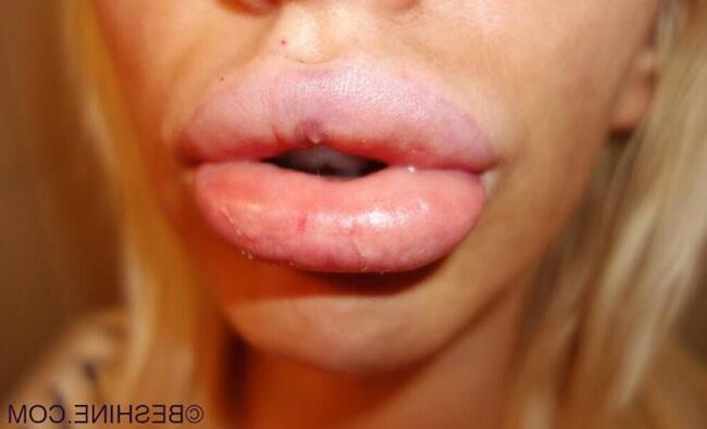 Lippen